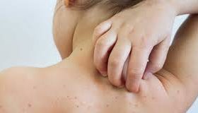 १६ जिल्लाका एक हजारभन्दा धेरै बालबालिका दादुराबाट सङ्क्रमित,खोपबाट नछुटाउन स्वास्थ्य मन्त्रालयको अनुरोध