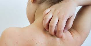 १६ जिल्लाका एक हजारभन्दा धेरै बालबालिका दादुराबाट सङ्क्रमित,खोपबाट नछुटाउन स्वास्थ्य मन्त्रालयको अनुरोध